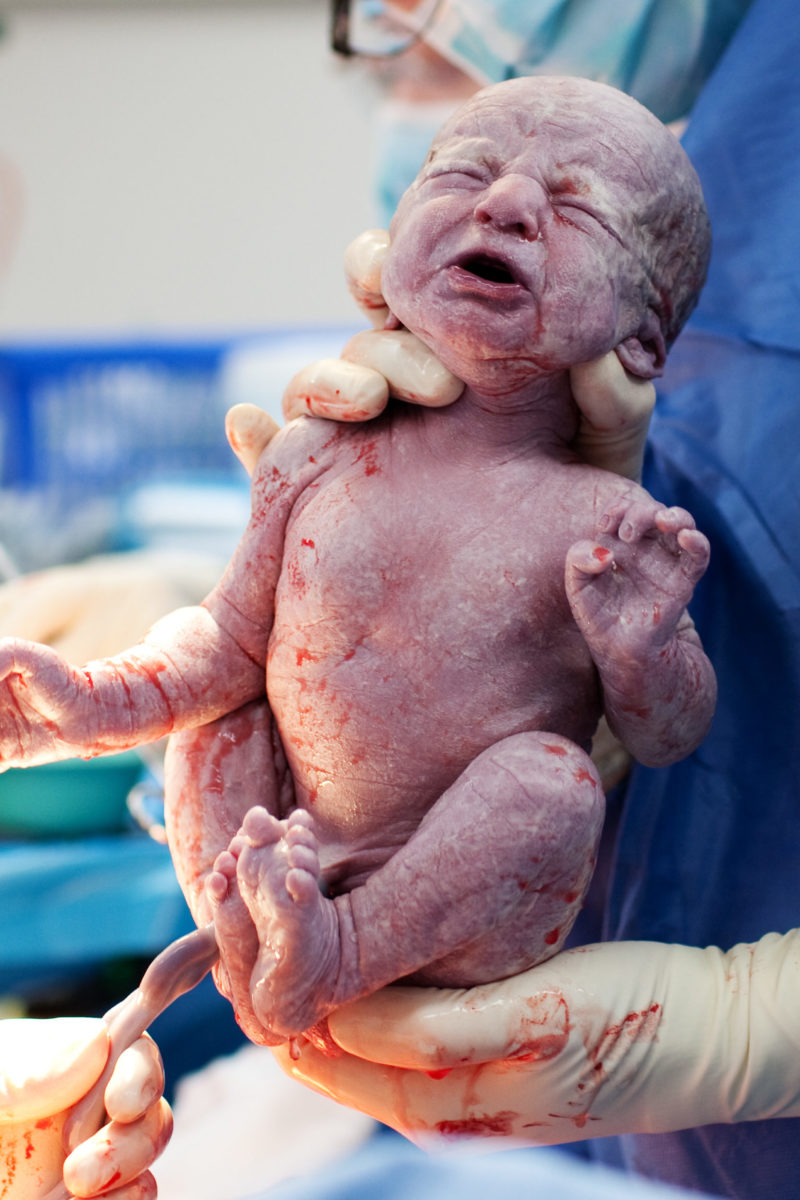 Baby being born via C-Section